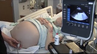 Ultrasound for Paracentesis  BAVLS [upl. by Tnairb]