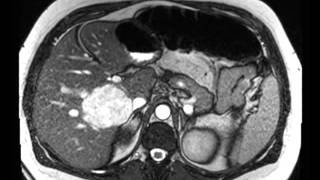 Liver Hemangioma [upl. by Adnalu]