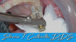 Loose Implant Screw  Dental Minute with Steven T Cutbirth DDS [upl. by Harwell767]