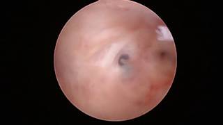 Histeroscopia diagnóstica  Diagnostic hysteroscopy [upl. by Anohsal]