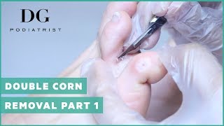 Corn Removal with callus  Double corn Part 1 Right Foot [upl. by Dickman]