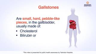 Gallstones  Cholelithiasis Symptoms Causes Diagnosis and Treatment [upl. by Worrad]