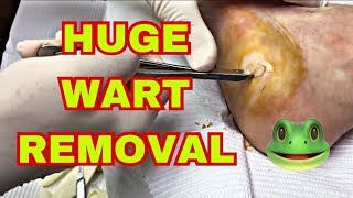 Large Wart Removal from Foot [upl. by Ahsuatal417]