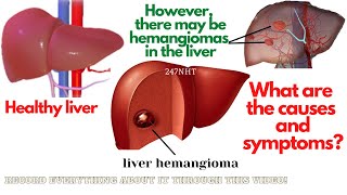 Giant Liver Hemangioma With Cystic Degeneration on MRI [upl. by Ayotal]