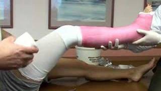 application of a long leg cast [upl. by Yeleen]