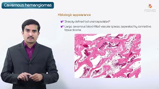 Microvenular Hemangioma 5Minute Pathology Pearls [upl. by Lydell877]