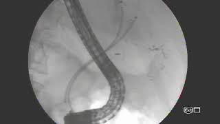 EPIC biliary stent placement [upl. by Levey31]