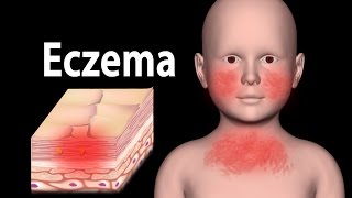 Eczema Animation [upl. by Aicenat895]