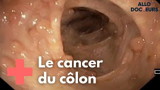 Cancer colorectal  quelle prise en charge   Allo Docteurs [upl. by Lejna23]