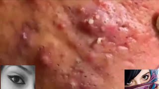 Severe Cystic Acne Infection Treatment Young Age [upl. by Dorina]