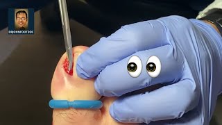 Podiatrist Removes Ingrown Toenail Permanently with Before and After Photos [upl. by Carrel]