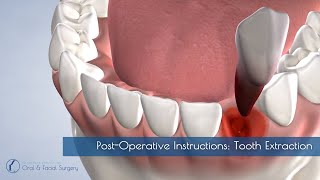 PostOperative Instructions Tooth Extraction [upl. by Dugaid]