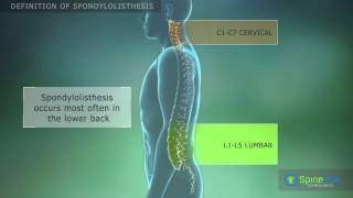 Spondylolisthesis Definition [upl. by Warden]