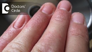 Atopic Dermatitis eczema From the Inside Out [upl. by Dennard690]