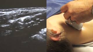 Ultrasound Guided Supraclavicular Nerve Block  SSRAUSAcom [upl. by Rieth]