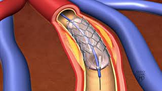 XEN Gel Stent Glaucoma Patient Video [upl. by Mead68]