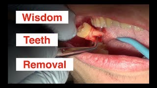 Wisdom Teeth Removal [upl. by Notla]