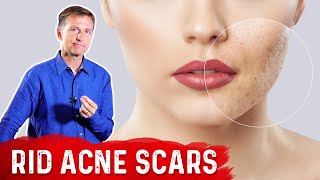 Best Way to Rid Acne Scars [upl. by Fenn]