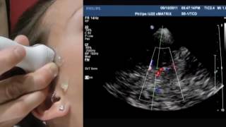 How To Transcranial Doppler [upl. by Lleon]