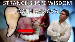 LOWER PARTIALLY ERUPTED WISDOM TOOTH REMOVAL Full procedure of extraction and explanation [upl. by Rocco598]