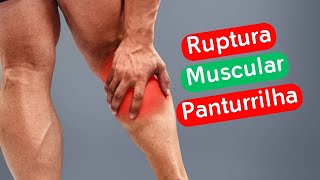 RUPTURA MUSCULAR PANTURRILHA  Dr Prof Nelson Marques [upl. by Aliwt]