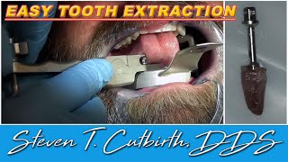 Easy Tooth Extraction  Dental Minute with Steven T Cutbirth DDS [upl. by Ahsiekram]