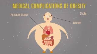 Obesity in America [upl. by Kirsti]