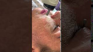 Fractional CO2 Laser Resurfacing [upl. by Hedgcock]