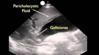 How To Gallbladder Ultrasound Part 3  Acute Cholecystitis Case Study Video [upl. by Immac]