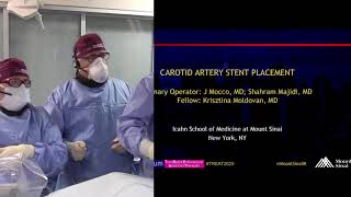 Transradial Carotid Artery Stenting [upl. by Alyahsat233]