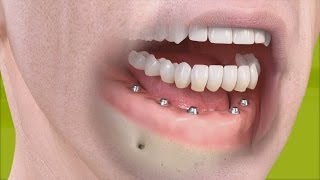 Straumann  Fixed restoration with 46 implants all straight [upl. by Rodd920]