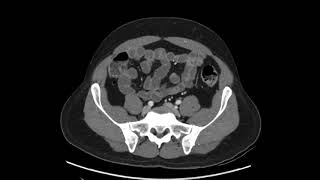 How to read a CT of the Abdomen and Pelvis  a quick practical approach axial [upl. by Corrine652]