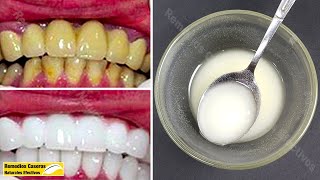 Blanquear Los Dientes En 2 Minutos Con Esta Mezcla Y Obtener Dientes Blancos Naturales [upl. by Rector]