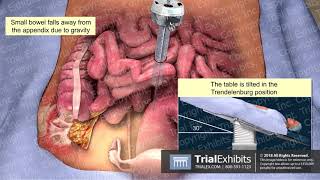 Laparoscopic Appendectomy [upl. by Erfert631]