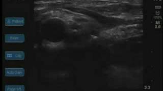 UltrasoundGuided Supraclavicular Brachial Plexus Block [upl. by Suhsoj]