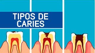 Tipos de caries  Odontoespecialistas [upl. by Seldon]