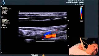 Hot Tips  Finding the Vertebral Artery with Ultrasound [upl. by Nnarefinnej]