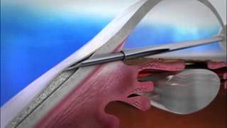 XEN glaucoma stent animation [upl. by Rivard893]