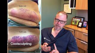 Sculpsure vs Coolsculpting  Which One is Better [upl. by Lledner974]