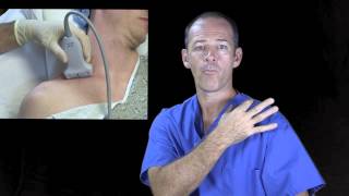 Supraclavicular nerve block ultrasound guided [upl. by Poucher]