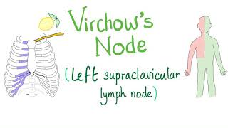 Virchows Node Left Supraclavicular Lymph Node  Cancer  Oncology [upl. by Tonkin678]