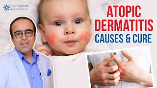 How is atopic dermatitis diagnosed [upl. by Mikiso]