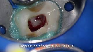 MTA pulpotomy – Video abstract ID 134315 [upl. by Rooke754]