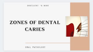 DENTAL CARIES ZONES [upl. by Yelak159]