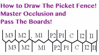 Occlusion  Picket Fence  NBDE Part 1 Boards Study [upl. by Nalyad]