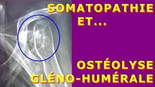 Ostéolyse GlénoHumérale et Somatopathie [upl. by Saxet]