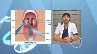 Bademcik İltihaplanması Belirtileri ve Tedavisi Bademcik Ameliyatı Nasıl Yapılır [upl. by Asseralc]