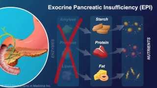 Exocrine Pancreatic Insufficiency [upl. by Obaza]