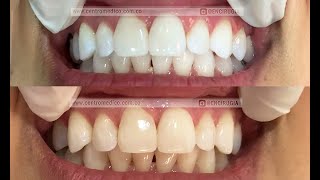 Blanqueamiento Dental Paso a Paso [upl. by Harland]