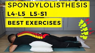 Spondylolisthesis treatment [upl. by Acino613]